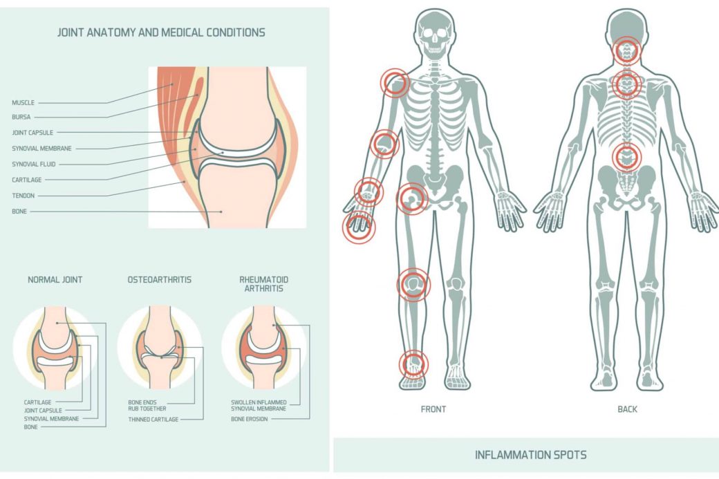 what is arthritis