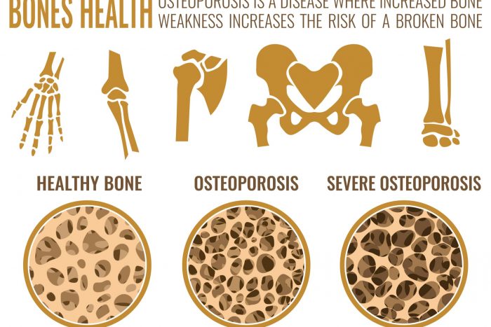 what is Osteoporosis