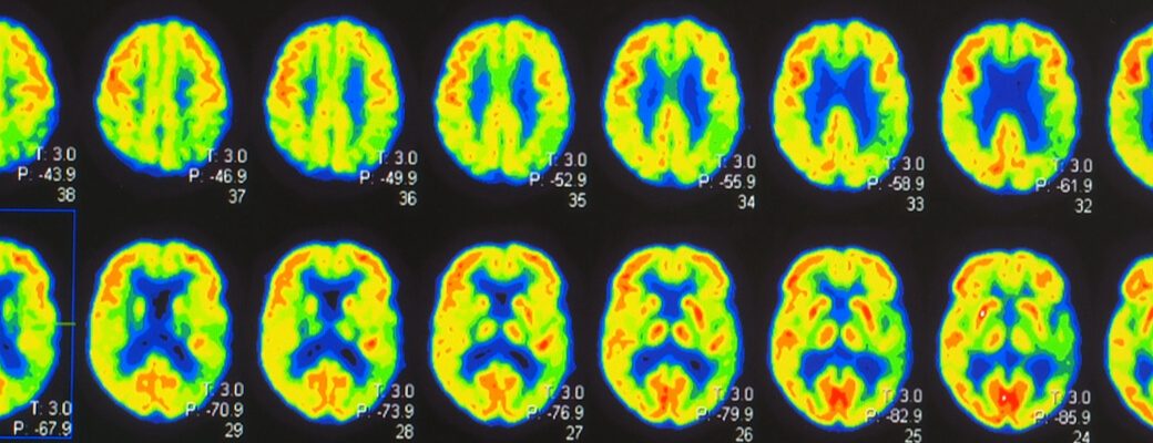 Positron Emission Tomography Test