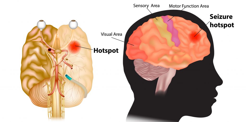 Can Alzheimer's Cause Seizures? 10-22% Of Patients With ...